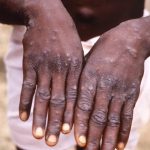 rio-de-janeiro-registra-119-casos-de-mpox